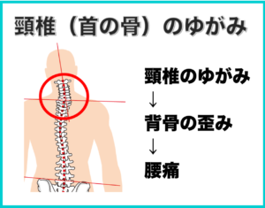 頸椎（首の骨）の歪みによる腰痛