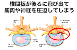 太もも裏の痛みとしびれの原因 別府整体姿勢専門サロンゆのまち 大分県別府市の整体院 姿勢専門サロンゆのまち