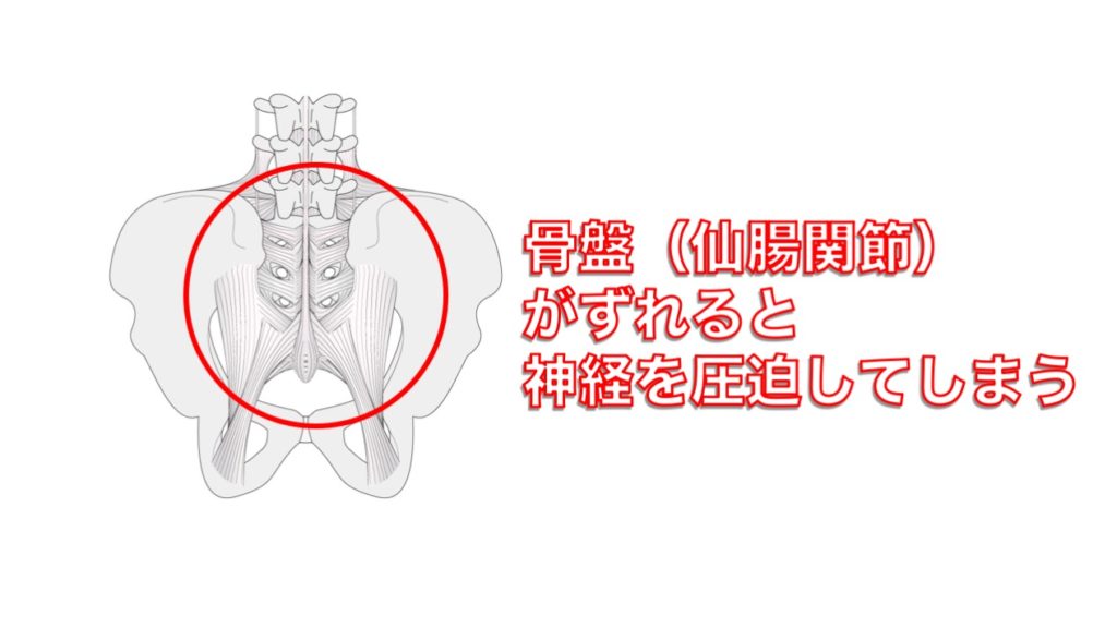 骨盤の歪み（仙腸関節）が足のしびれとおしりの痛みの原因に　別府整体姿勢専門サロンゆのまち
