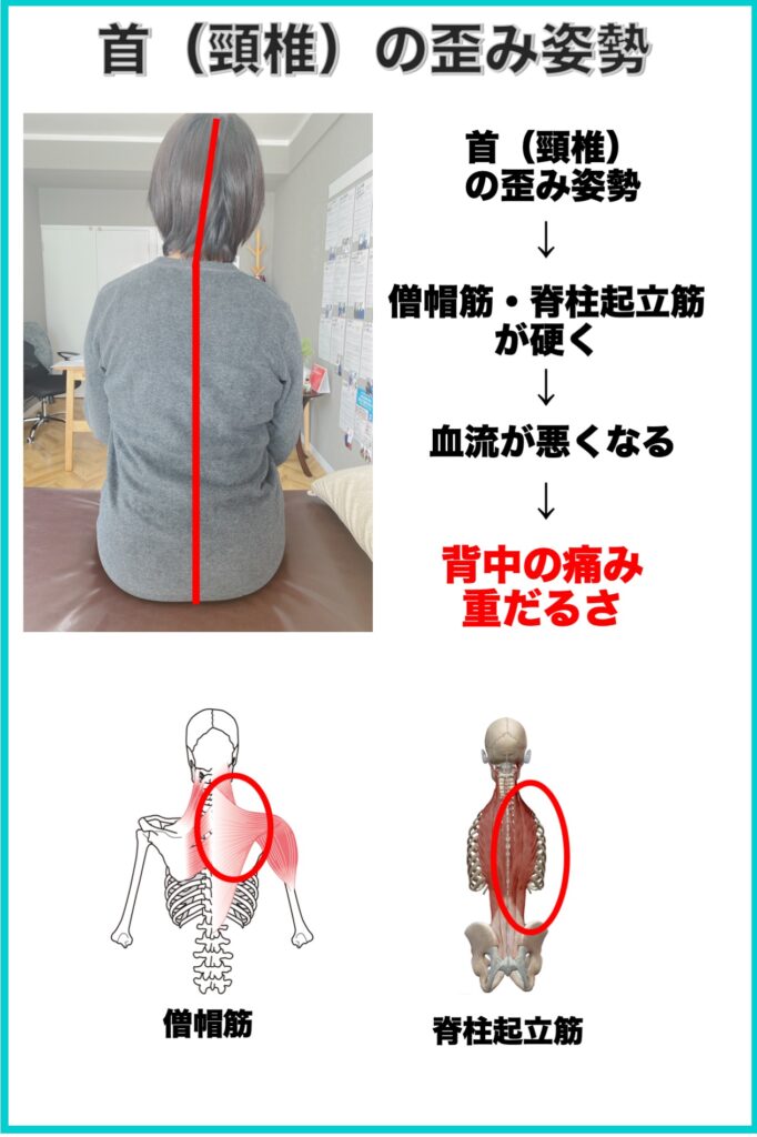 別府整体姿勢専門サロンゆのまち　頸椎の歪み姿勢と背中の痛みの関係性